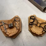 Metall-3D-gedrucktes Dentalbauteil